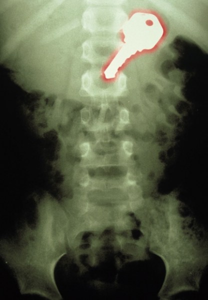 این عکس اشعه ایکس رنگی، کلیدی را نشان می‌دهد که توسط یک پسر بچه 7 ساله بلعیده شده است.