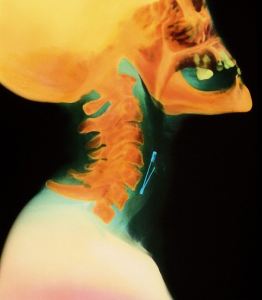 ک عکس رادیولوژی رنگی از یک سنجاق که در مری یک زن فرو رفته است.