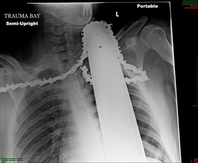 این عکس اشعه ایکس از قفسه سینه، اره‌ای دندانه‌دار را نشان می‌دهد که در گردن و شانه‌های والتاین فرو رفته است