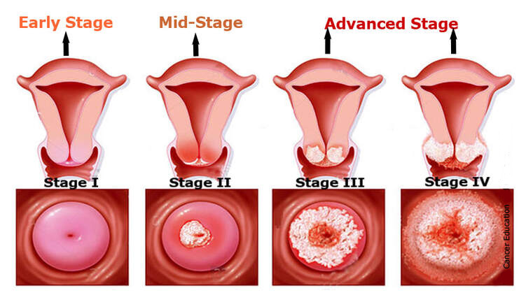 علائم سرطان دهانه رحم