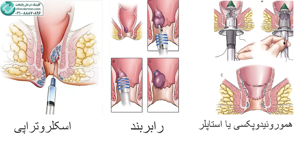 روش های عمل بواسیر