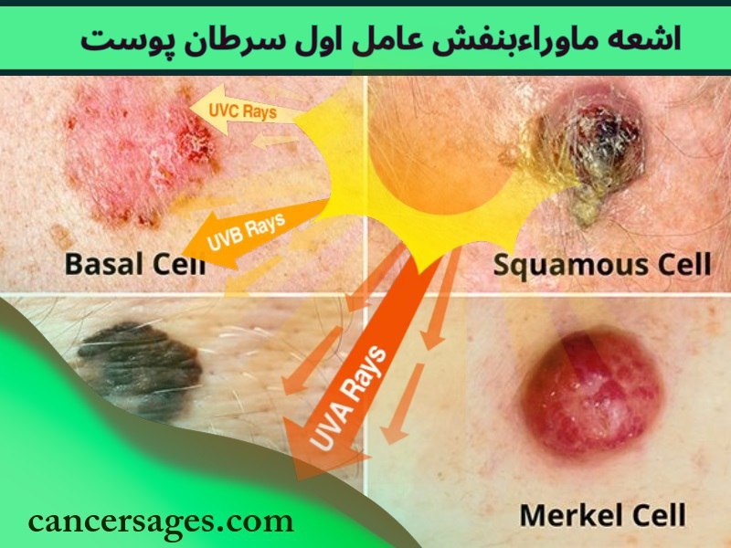 اشعه ماوراءبنفش؛ عامل اول سرطان پوست