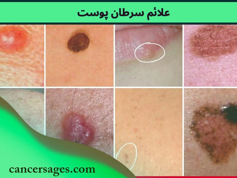 علائم سرطان پوست