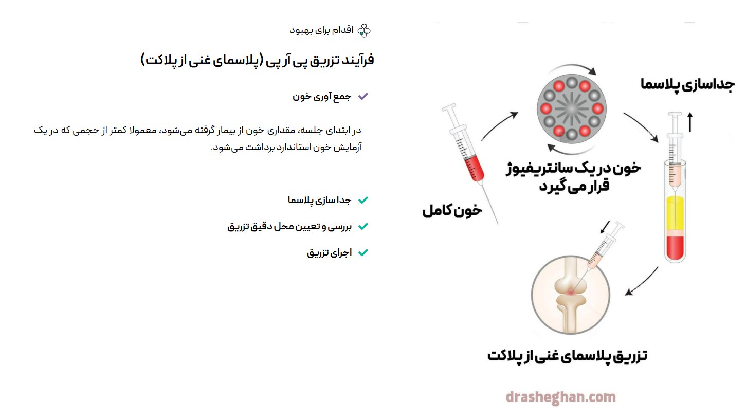فرآیند تزریق پی آر پی (پلاسمای غنی از پلاکت)