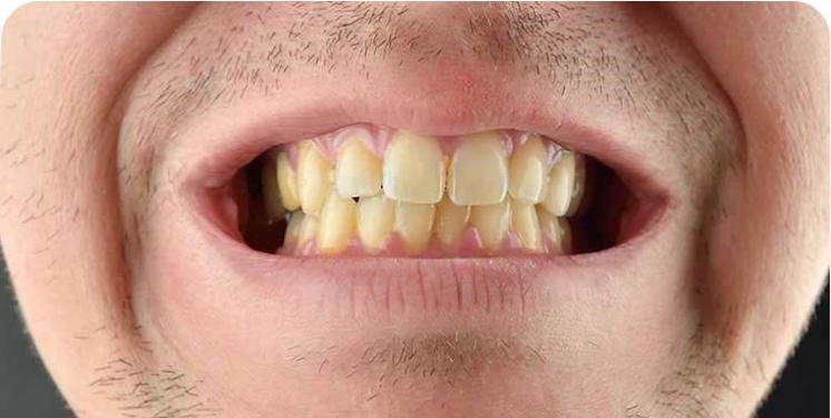 دندان مصنوعی